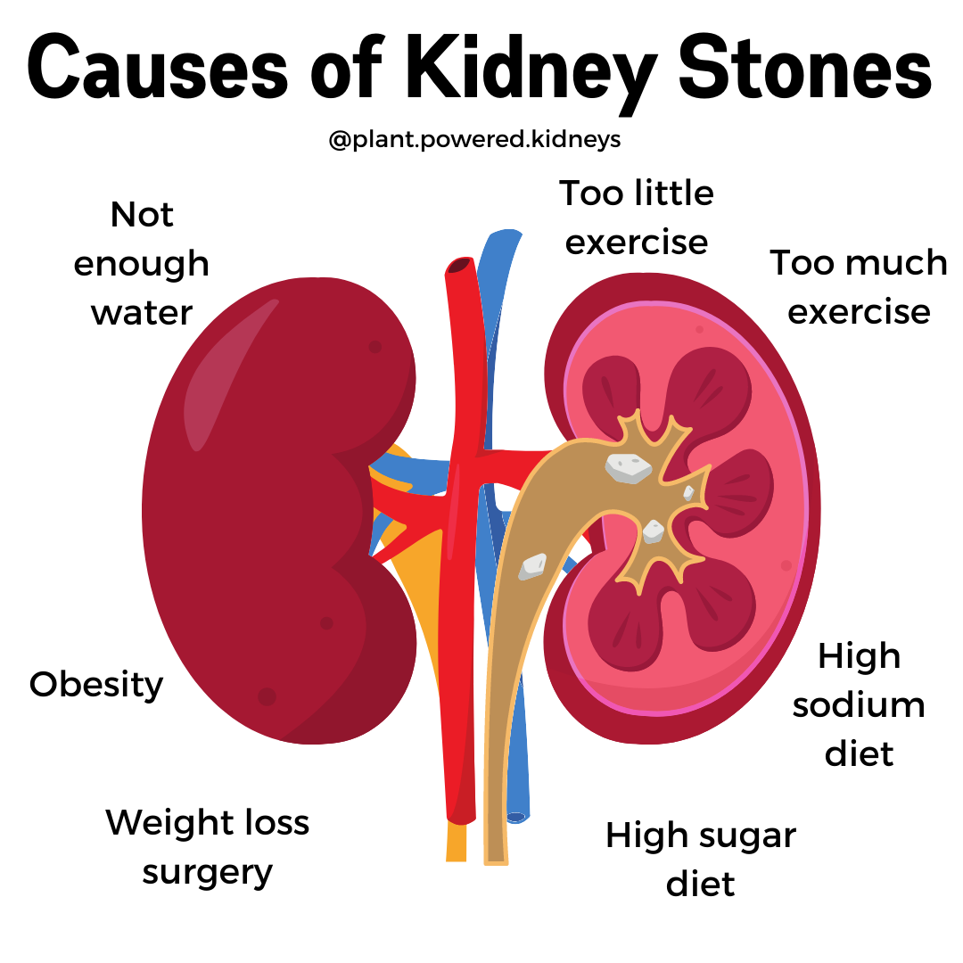 Apple Cider Vinegar for Kidney Stones PlantPowered Kidneys Renal