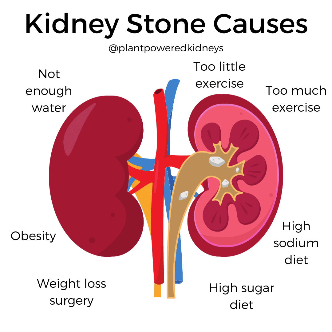 Can apple cider vinegar cause kidney stones discount