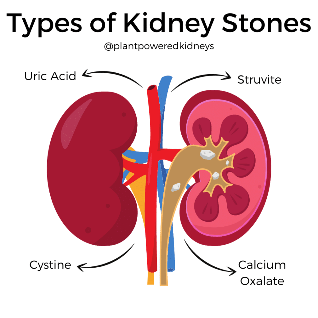 Apple Cider Vinegar for Kidney Stones The truth Behind It